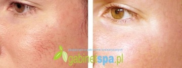 ND-YAG LASER для закрытия судов мезолазер