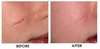 Revitol Scar Cream от шрамов, шрамов от прыщей.